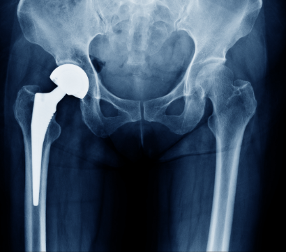 Hip  Femur Joints