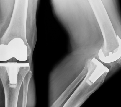 Knee Joint